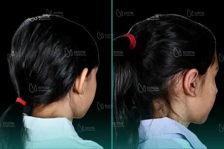 Before-After Combined