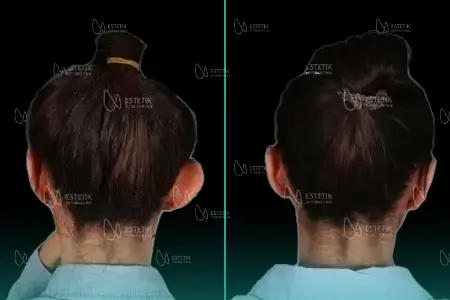 Before-After Combined