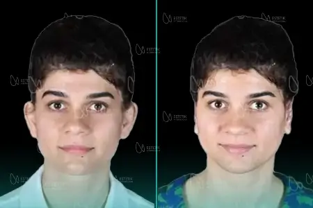 Before-After Combined