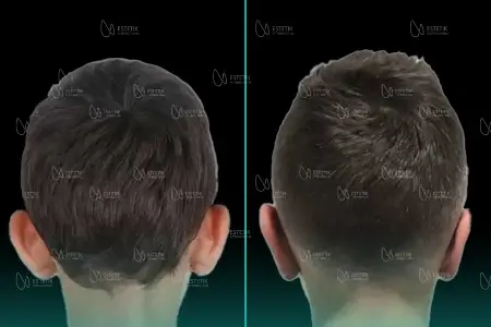 Before-After Combined