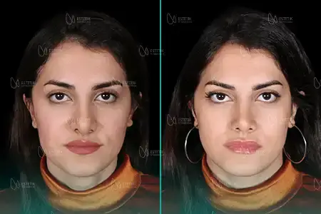 Before-After Combined