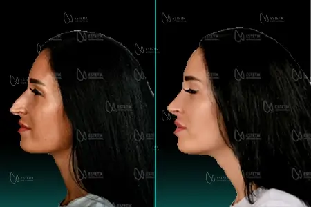 Before-After Combined