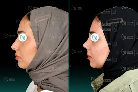 Before-After Combined