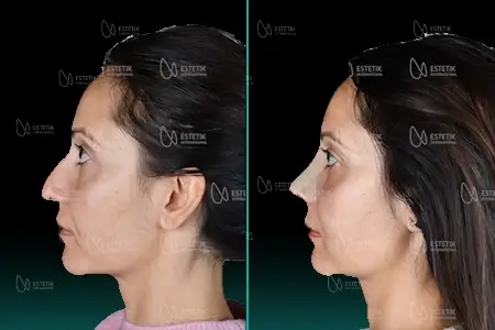 Before-After Combined