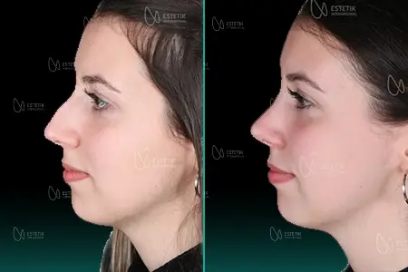 Before-After Combined