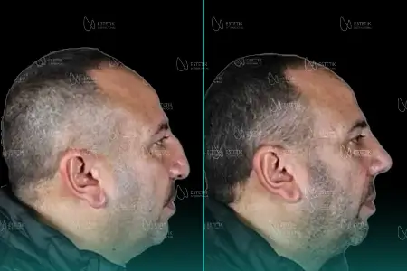 Before-After Combined