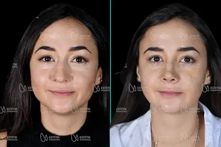 Before-After Combined