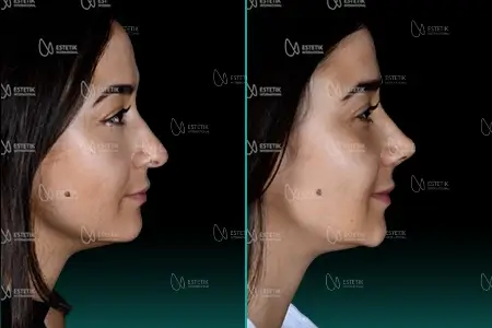 Before-After Combined