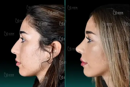 Before-After Combined