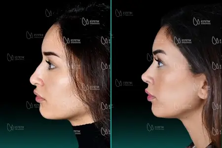 Before-After Combined