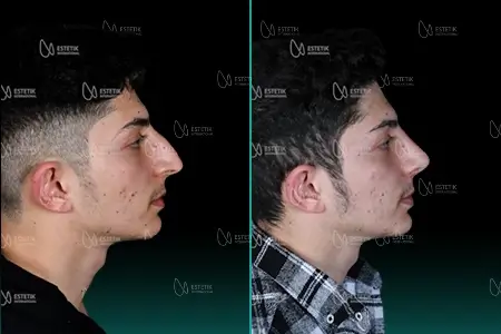 Before-After Combined