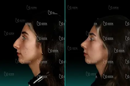Before-After Combined