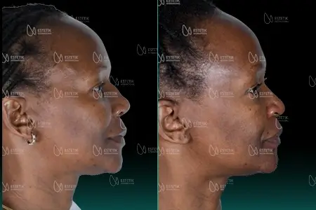 Before-After Combined