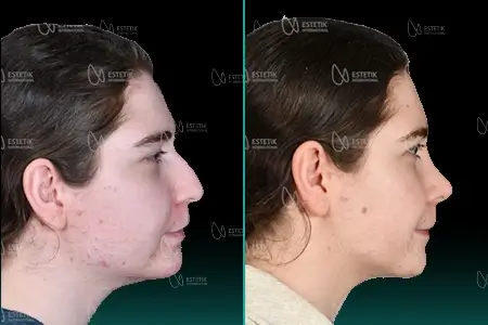 Before-After Combined