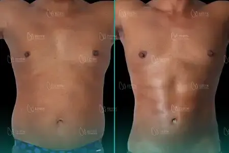 Before-After Combined