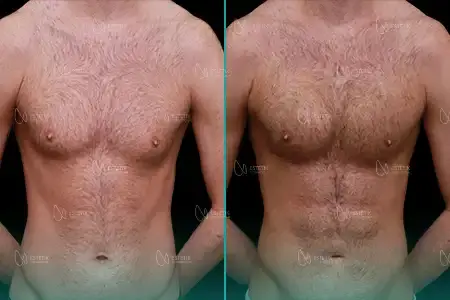 Before-After Combined