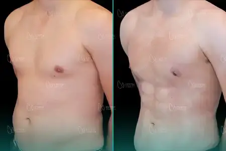 Before-After Combined