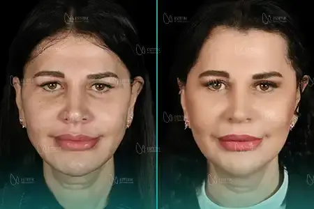 Before-After Combined