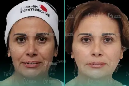 Before-After Combined