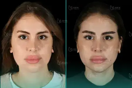 Before-After Combined
