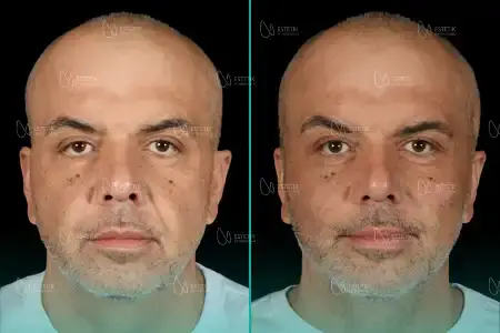 Before-After Combined