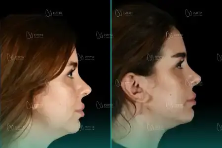 Before-After Combined