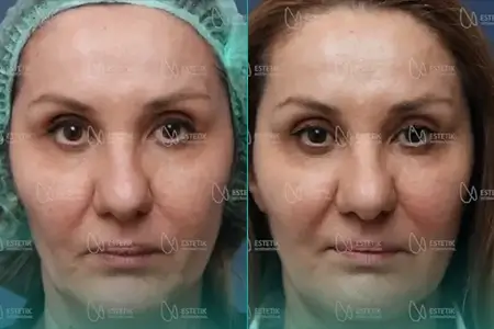 Before-After Combined