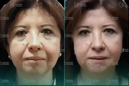 Before-After Combined