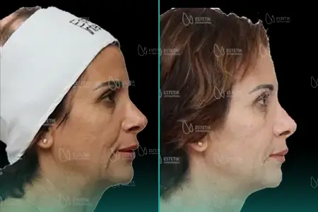 Before-After Combined
