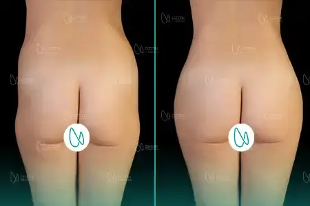 Before-After Combined