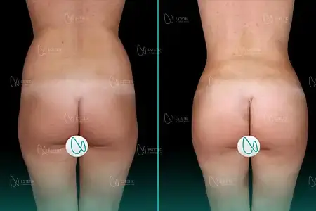 Before-After Combined