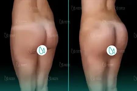 Before-After Combined