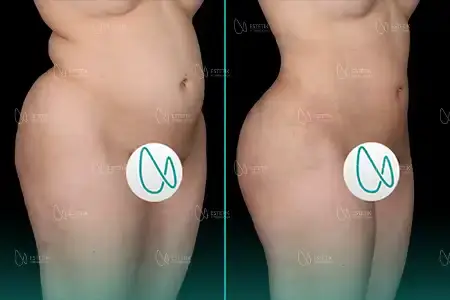 Before-After Combined