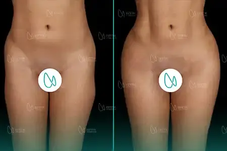 Before-After Combined