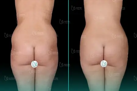 Before-After Combined