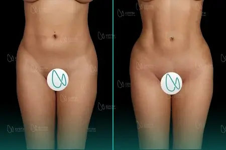 Before-After Combined