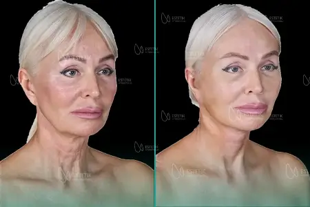 Before-After Combined