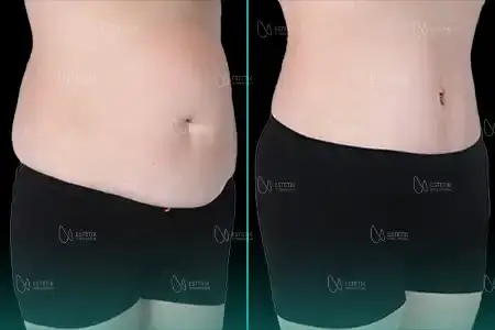 Before-After Combined