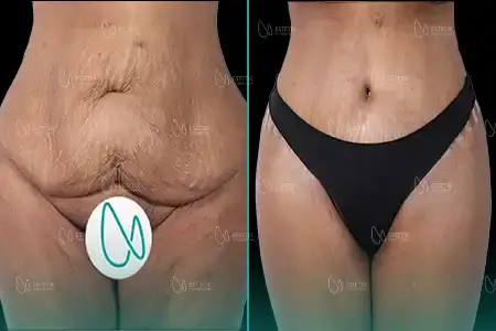 Before-After Combined