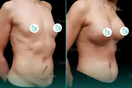 Before-After Combined