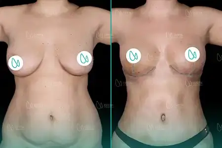 Before-After Combined
