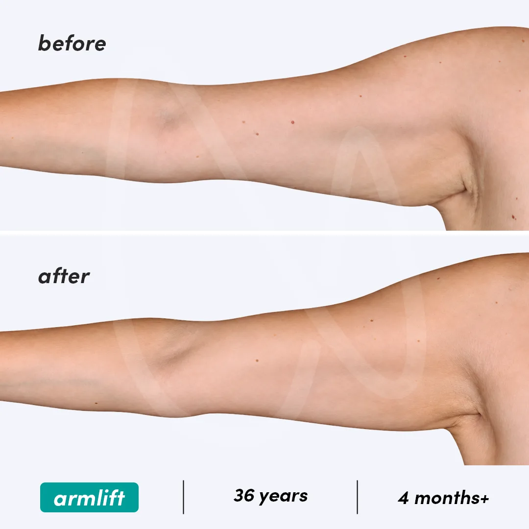 Подтяжка рук – До и После 3