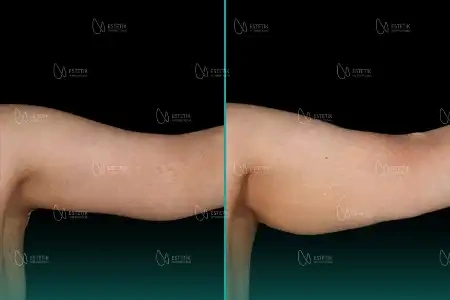 Before-After Combined