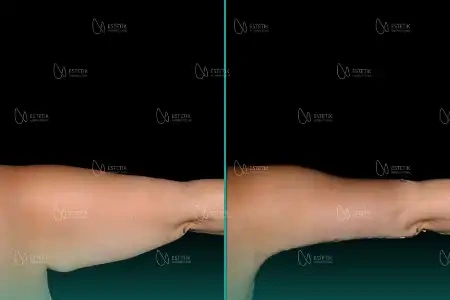 Before-After Combined