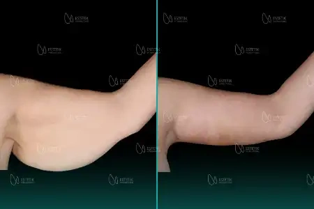 Before-After Combined