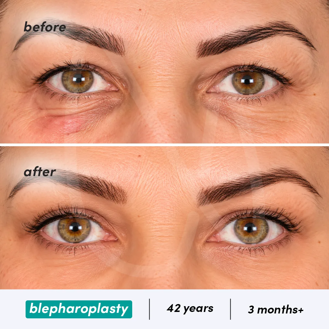 Before-After Combined