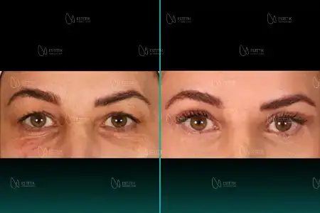 Before-After Combined