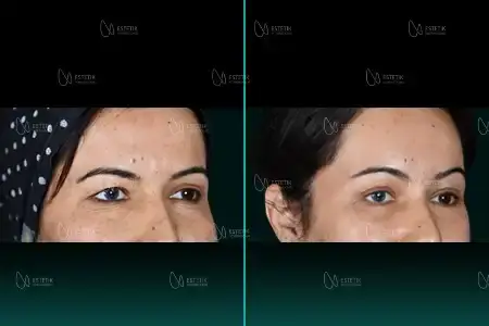Before-After Combined