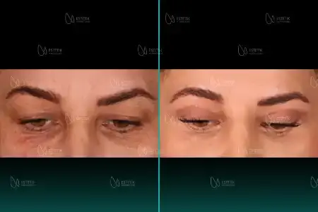 Before-After Combined