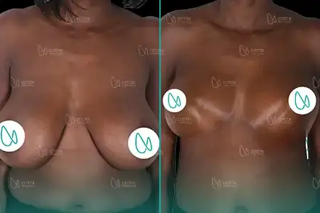 Before-After Combined